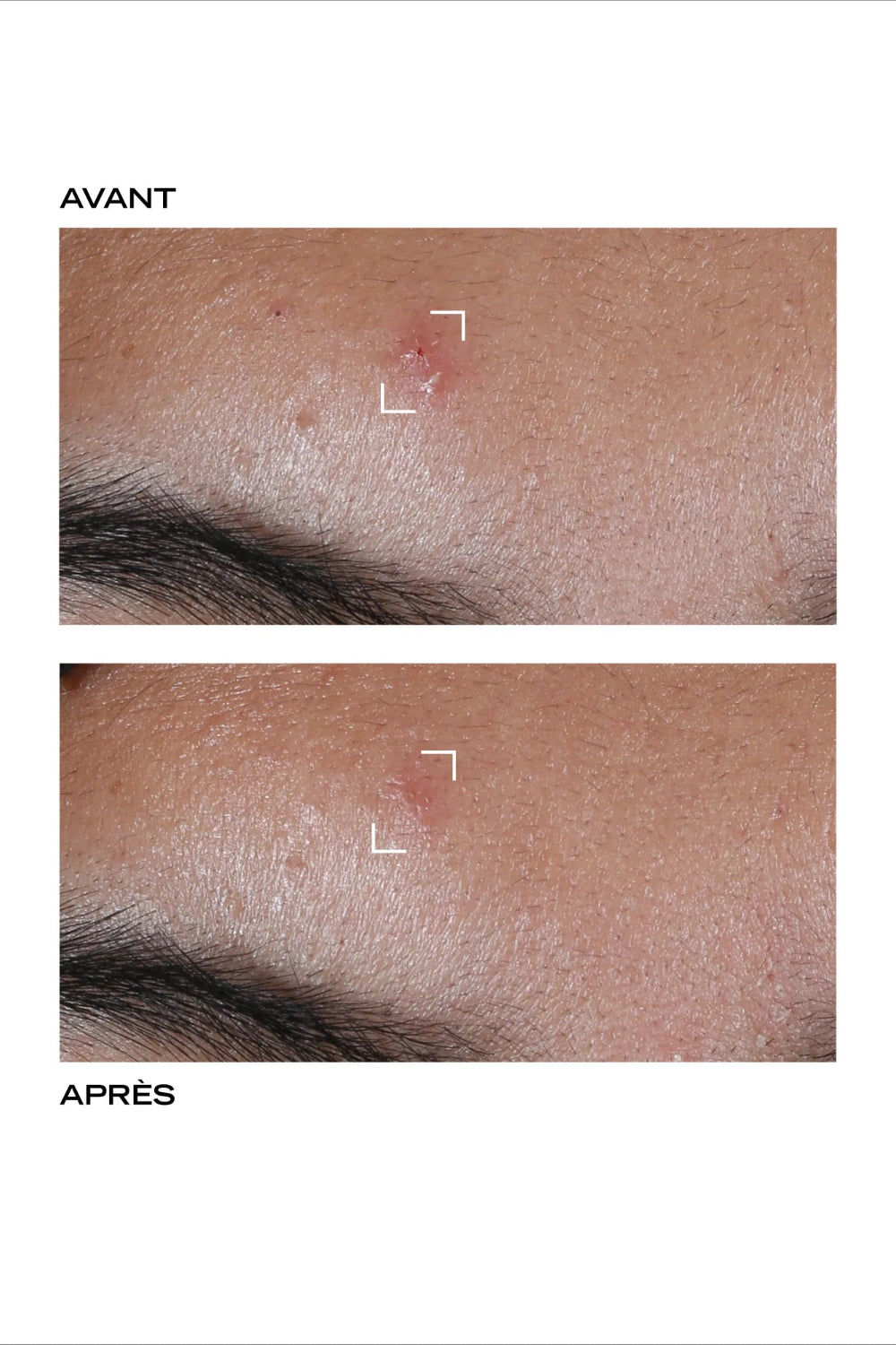 Pâte Grise - stop pimple original paste